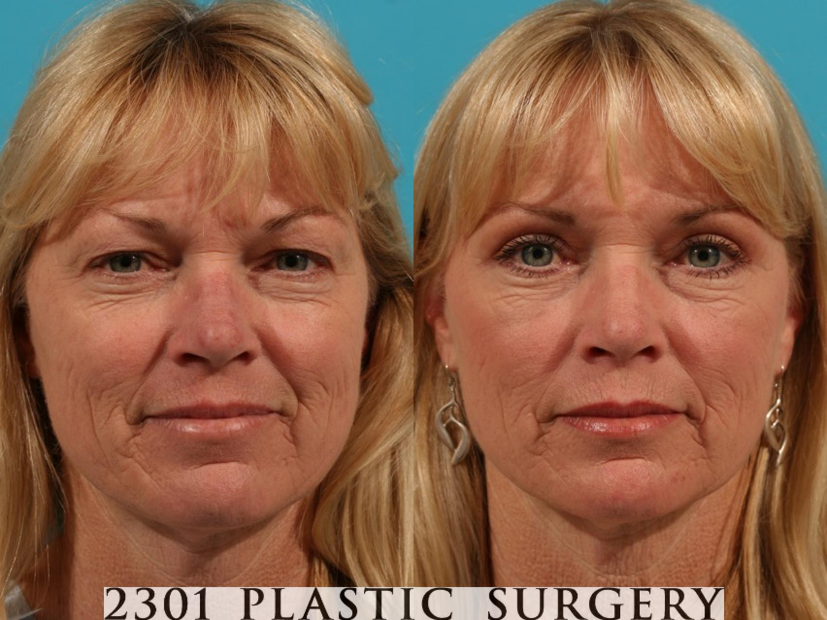 Before & After Blepharoplasty Case 50 View #1 View in Fort Worth, Plano, & Frisco, Texas
