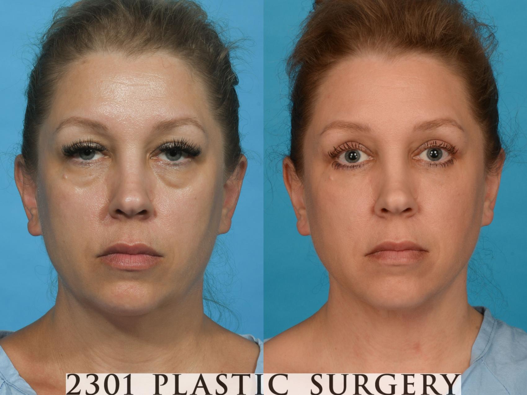 Before & After Blepharoplasty Case 739 Front View in Fort Worth, Plano, & Frisco, Texas