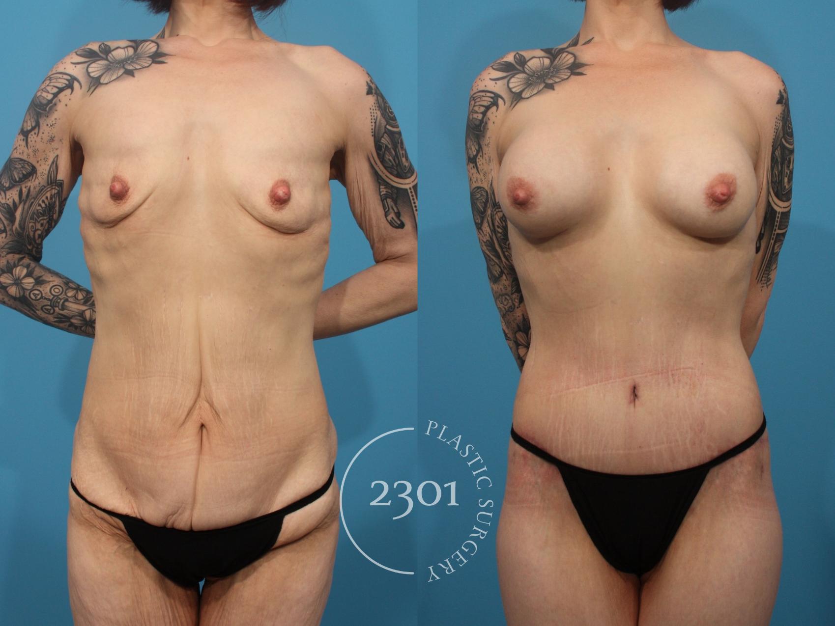 Before & After Body Lift Case 869 Front View in Fort Worth, Plano, & Frisco, Texas