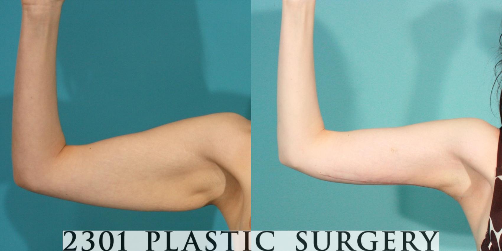 Before & After Brachioplasty Case 77 View #1 View in Fort Worth, Plano, & Frisco, Texas