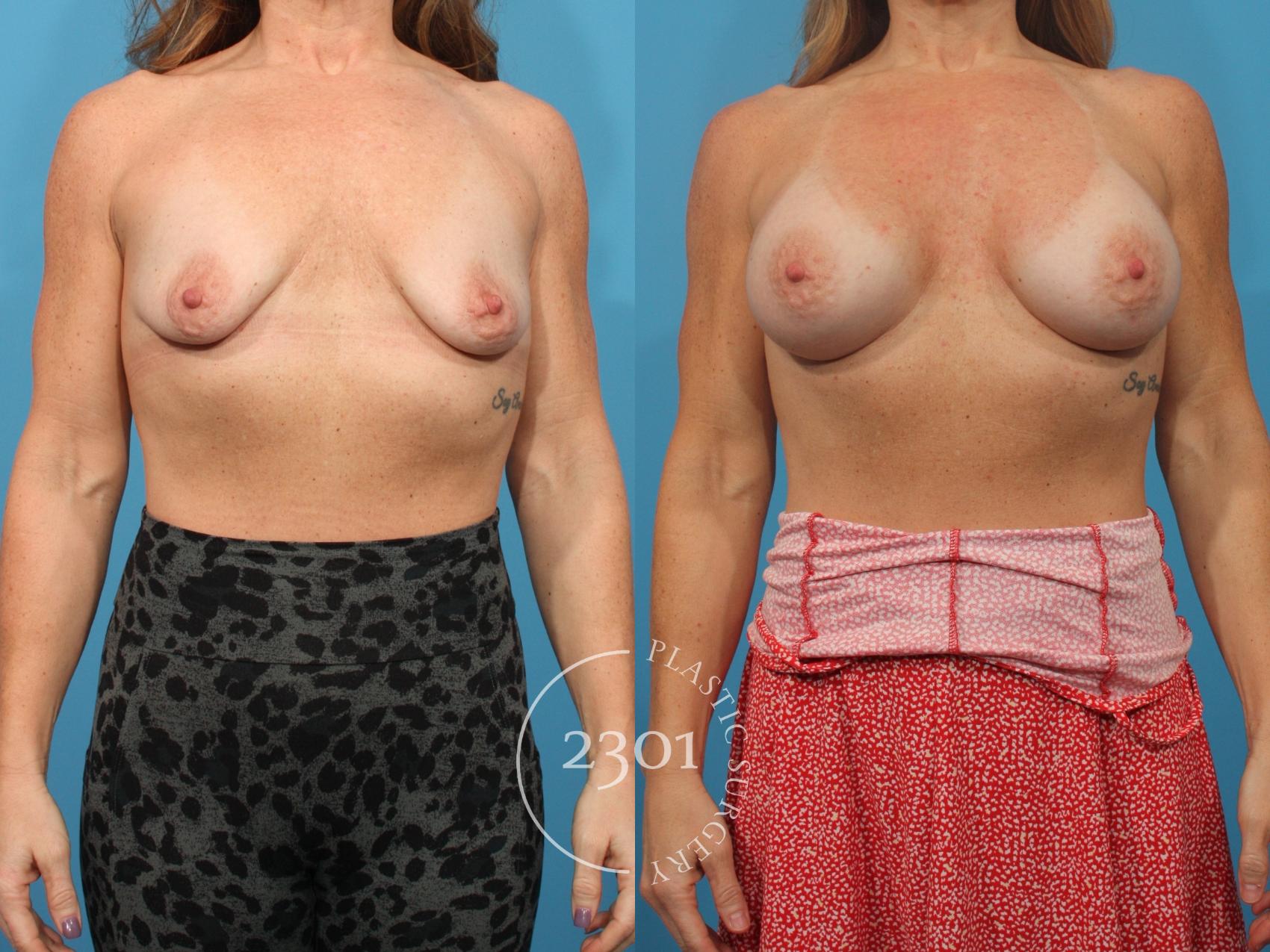 Before & After Breast Augmentation Case 874 Front View in Fort Worth, Plano, & Frisco, Texas