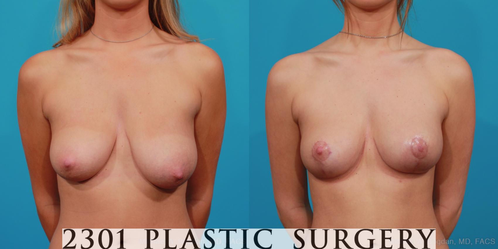 Before & After Breast Lift (Mastopexy) Case 320 View #1 View in Fort Worth, Plano, & Frisco, Texas