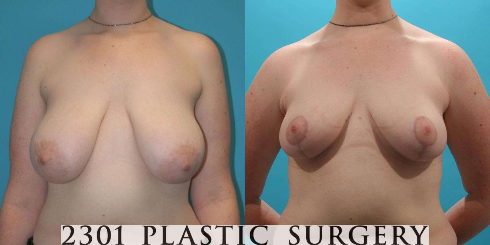Before & After Breast Reduction Case 27 View #1 View in Fort Worth, Plano, & Frisco, Texas