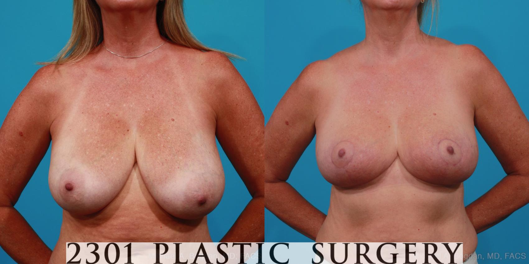 Before & After Breast Reduction Case 308 View #1 View in Fort Worth, Plano, & Frisco, Texas