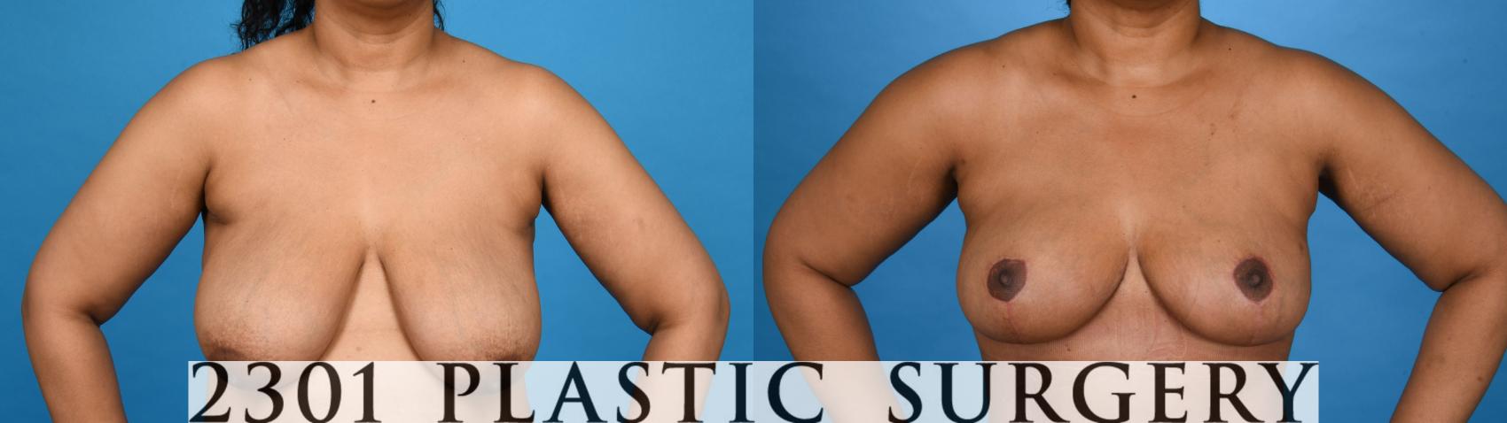 Before & After Breast Reduction Case 757 Front View in Fort Worth, Plano, & Frisco, Texas
