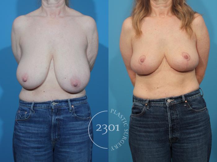 Before & After Breast Reduction Case 873 Front View in Fort Worth, Plano, & Frisco, Texas