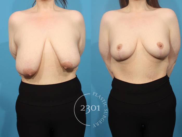 Before & After Breast Reduction Case 876 Front View in Fort Worth, Plano, & Frisco, Texas