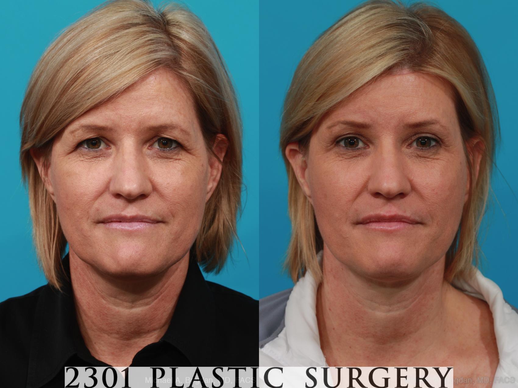 Before & After Brow Lift Case 299 View #1 View in Fort Worth, Plano, & Frisco, Texas
