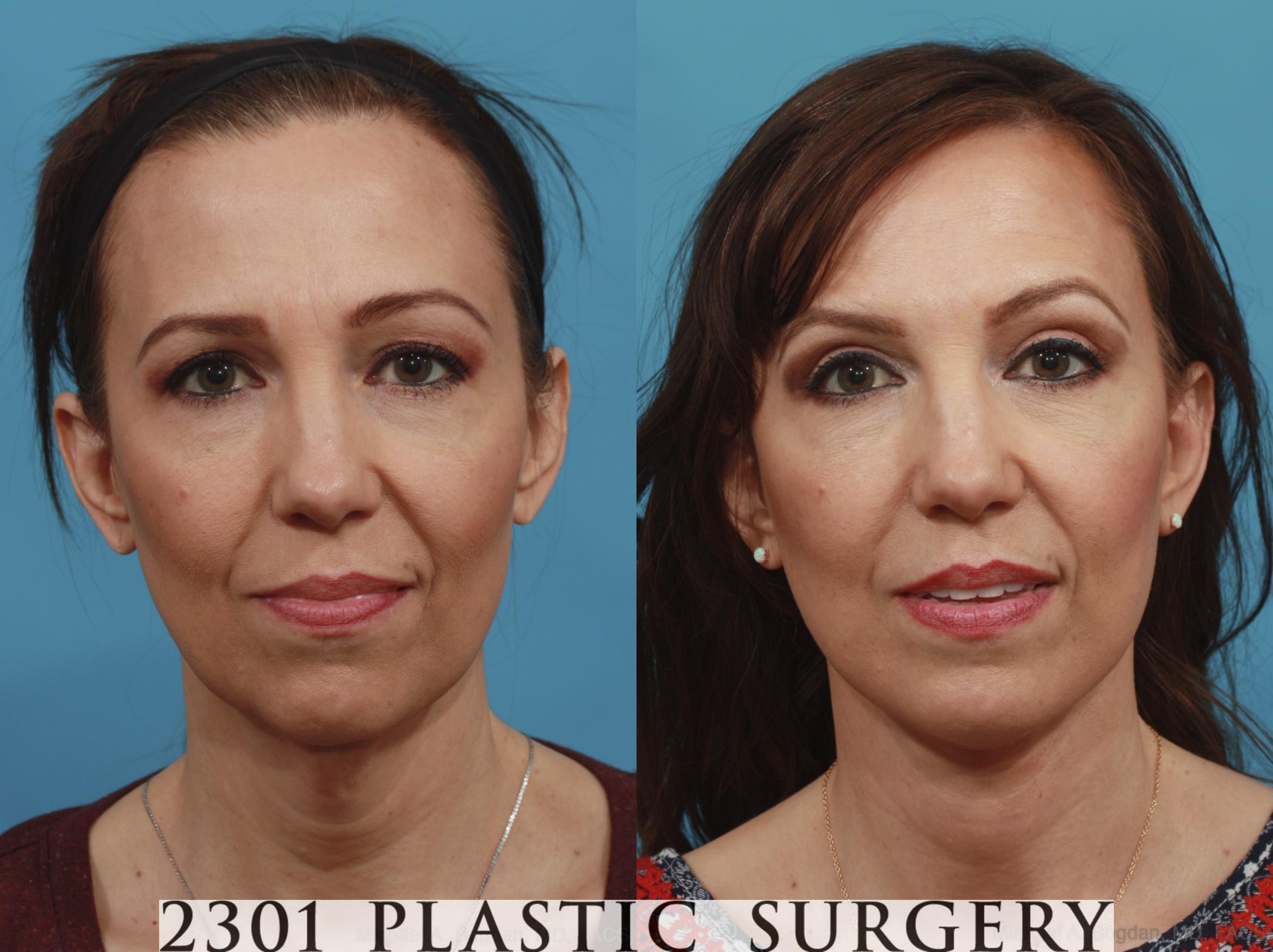 Face Lift Case 577 Before & After View #1 | Fort Worth & Frisco, Texas | Michael A. Bogdan, MD, FACS
