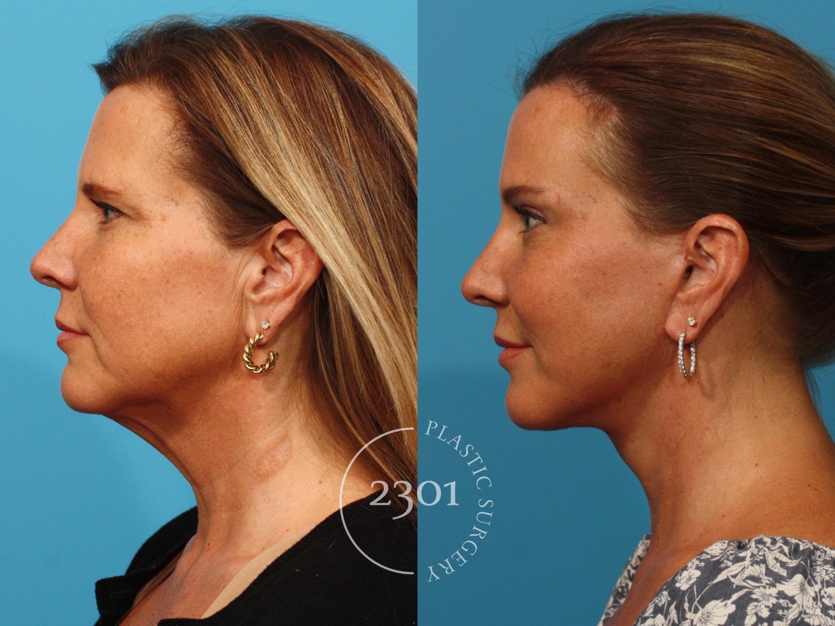 Before & After Face Lift Case 878 Left Side View in Fort Worth, Plano, & Frisco, Texas