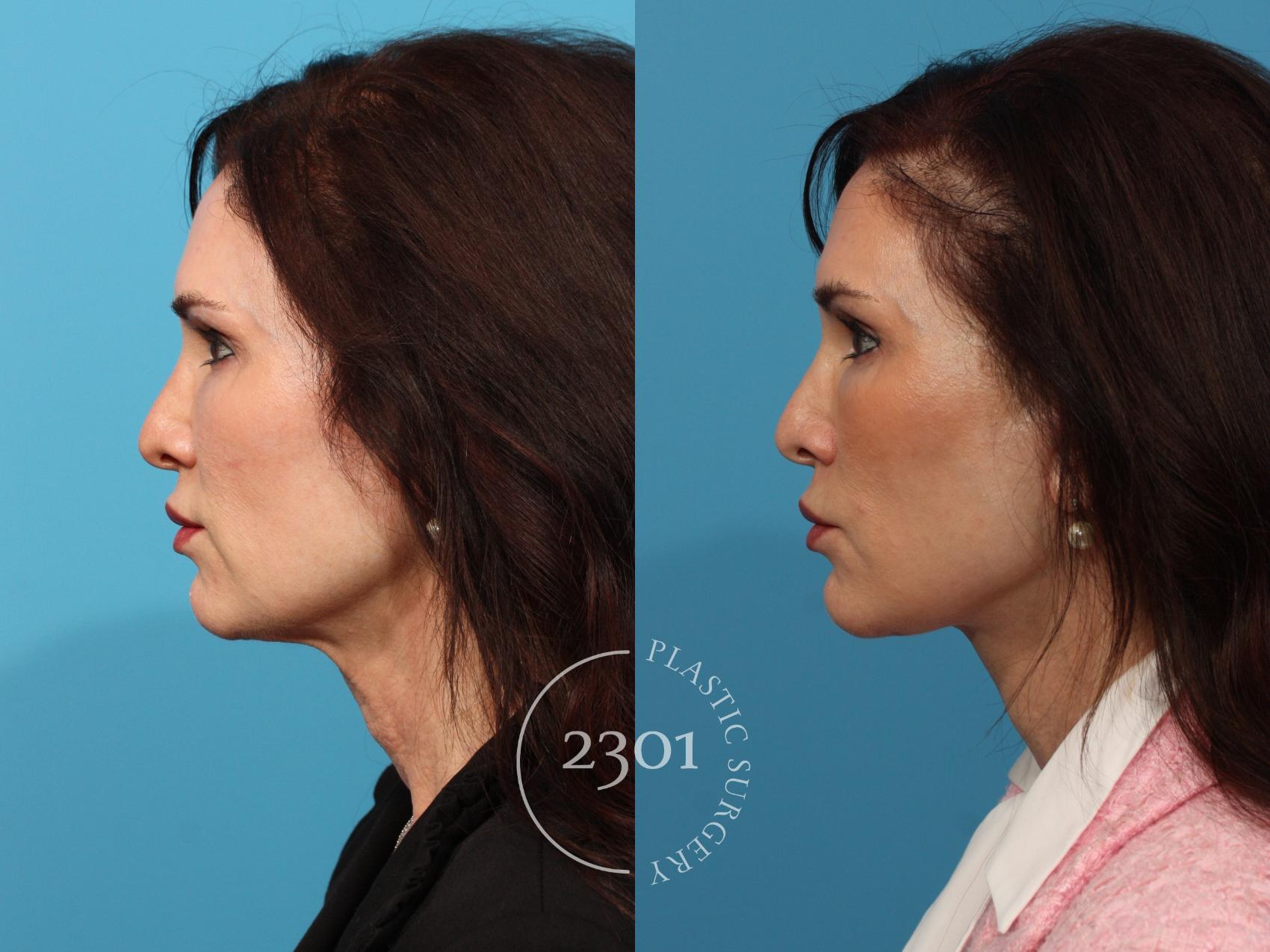 Before & After Face Lift Case 880 Left Side View in Fort Worth, Plano, & Frisco, Texas