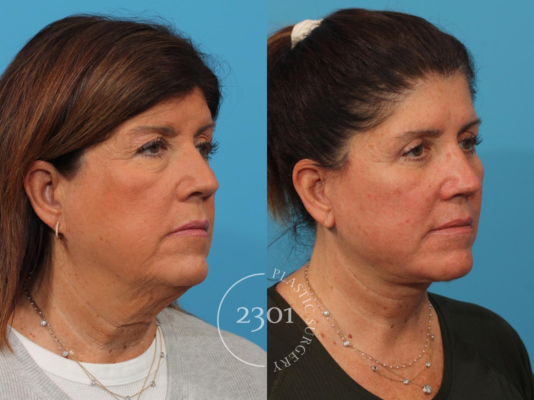 Before & After Face Lift Case 887 Right Oblique View in Fort Worth, Plano, & Frisco, Texas