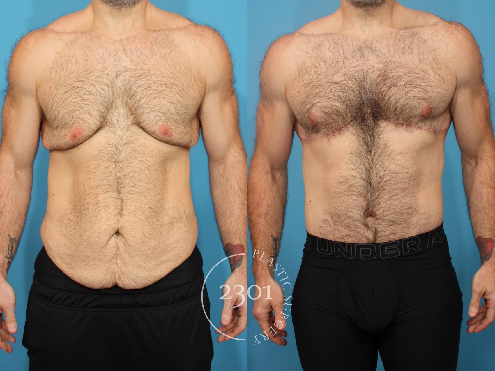 Before & After Male Tummy Tuck Case 883 Front View in Fort Worth, Plano, & Frisco, Texas