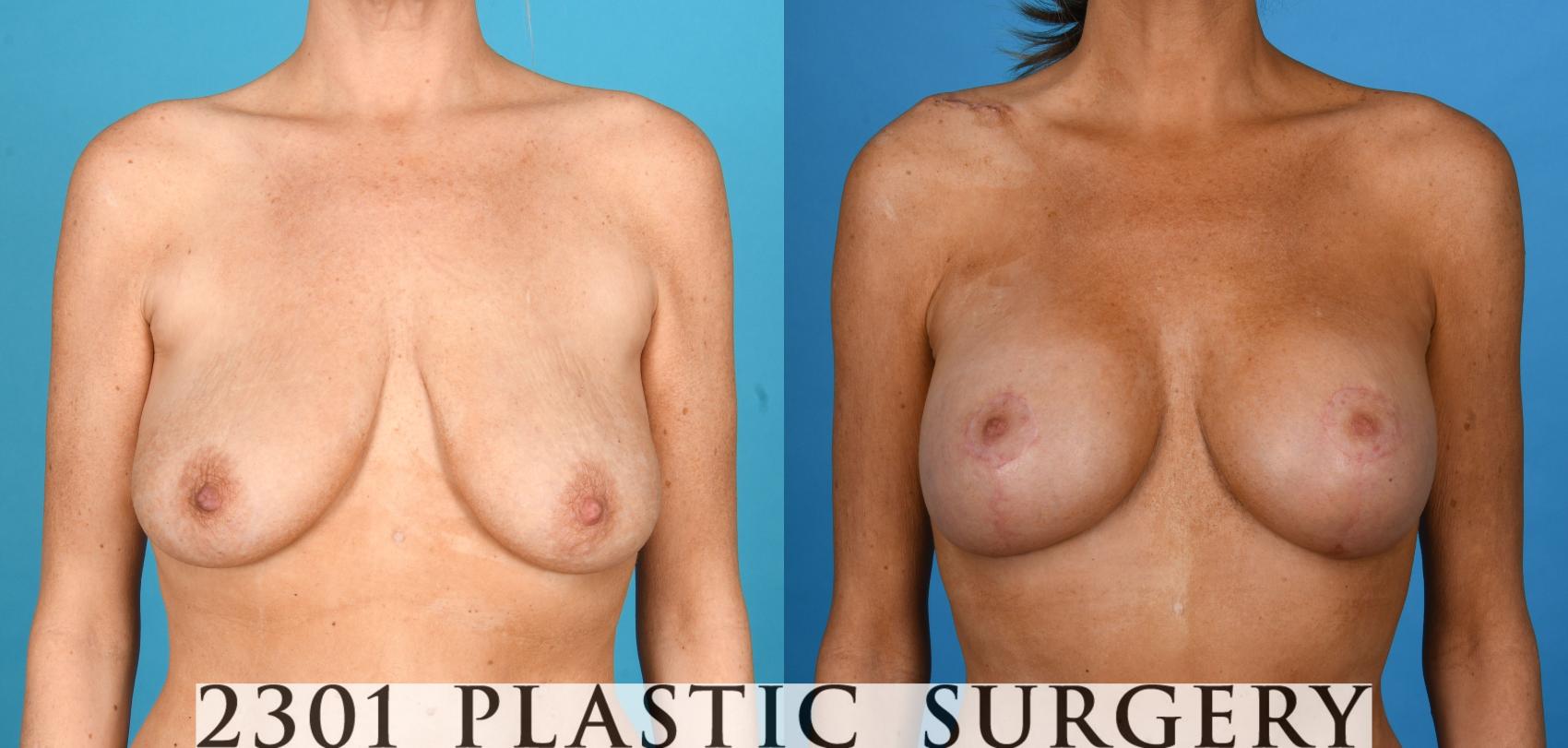 Before & After Mastopexy & Augmentation Case 747 Front View in Fort Worth, Plano, & Frisco, Texas