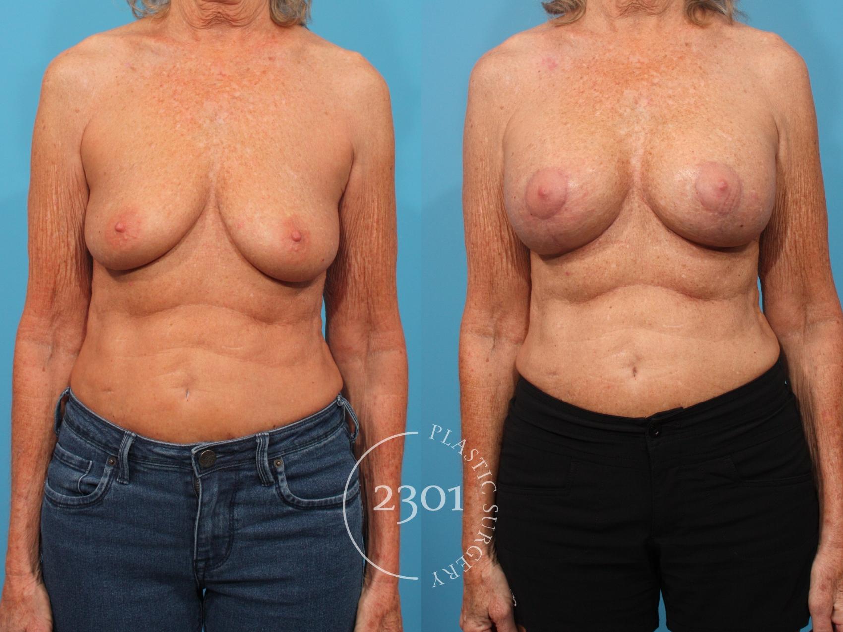 Before & After Mastopexy & Augmentation Case 870 Front View in Fort Worth, Plano, & Frisco, Texas