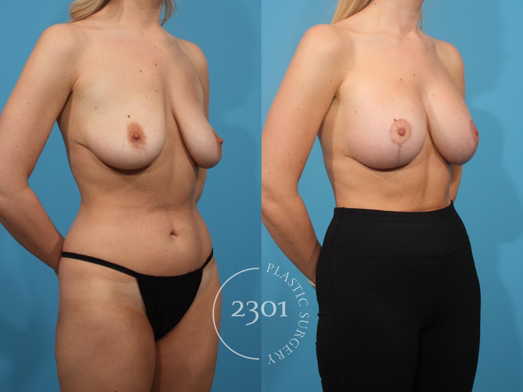 Before & After Mastopexy & Augmentation Case 884 Right Oblique View in Fort Worth, Plano, & Frisco, Texas