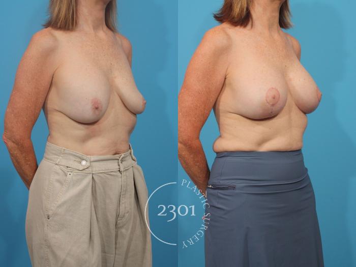 Before & After Mastopexy & Augmentation Case 889 Right Oblique View in Fort Worth, Plano, & Frisco, Texas