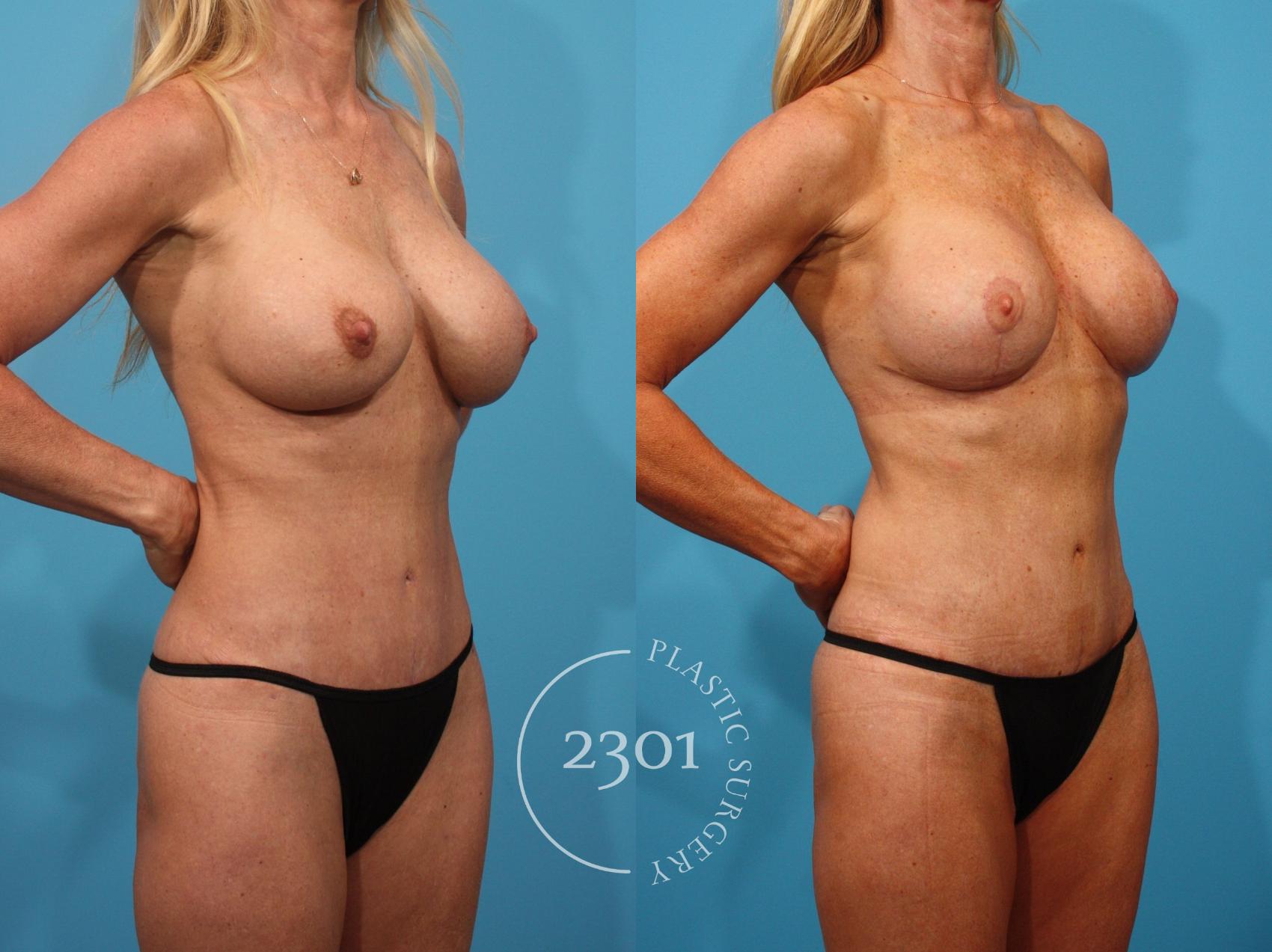 Before & After Breast Augmentation Revision Case 890 Right Oblique View in Fort Worth, Plano, & Frisco, Texas