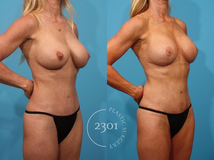 Before & After Breast Augmentation Revision Case 890 Right Oblique View in Fort Worth, Plano, & Frisco, Texas