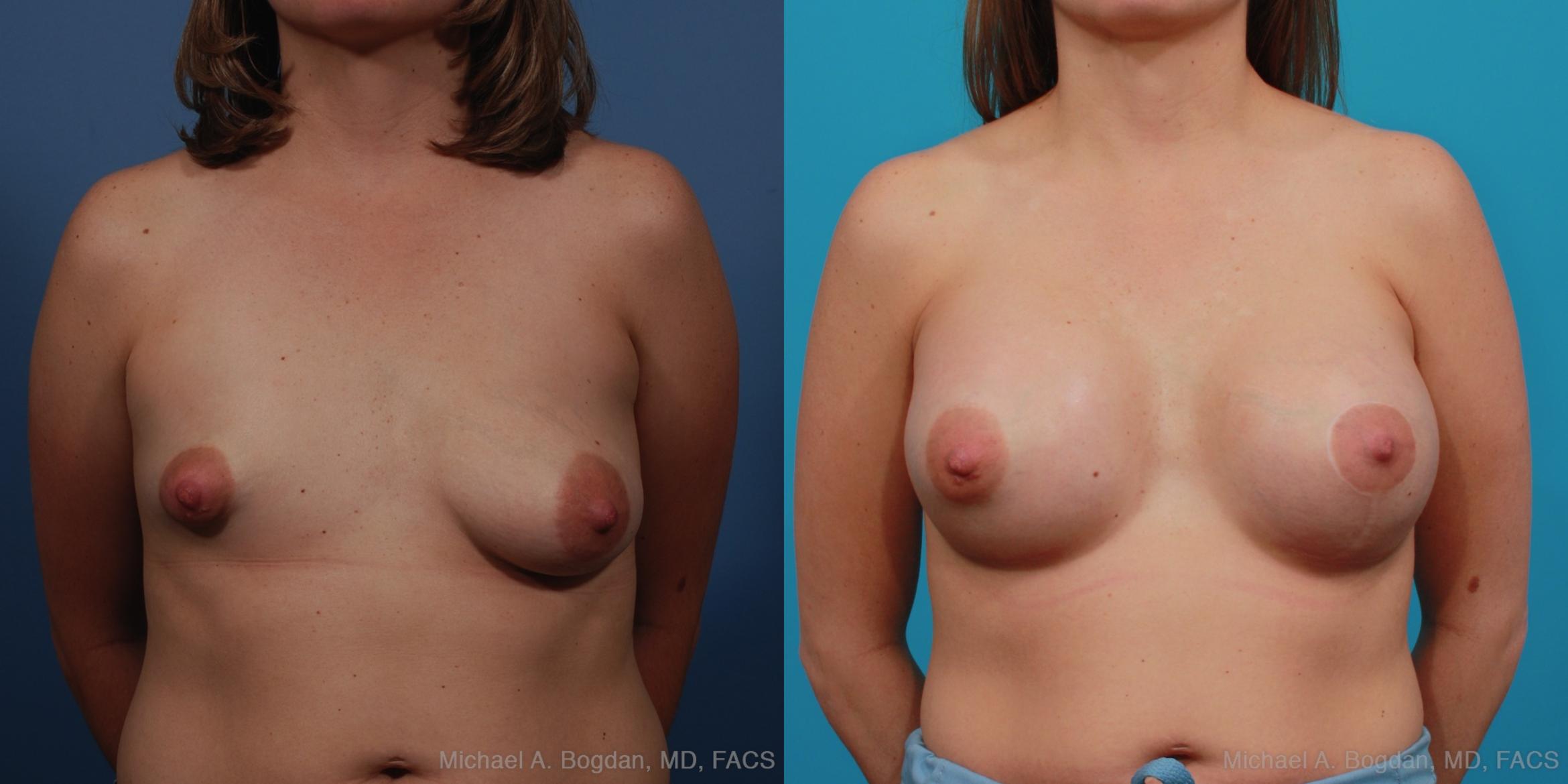 Mastopexy & Augmentation Case 340 Before & After View #1 | Fort Worth & Frisco, Texas | Michael A. Bogdan, MD, FACS