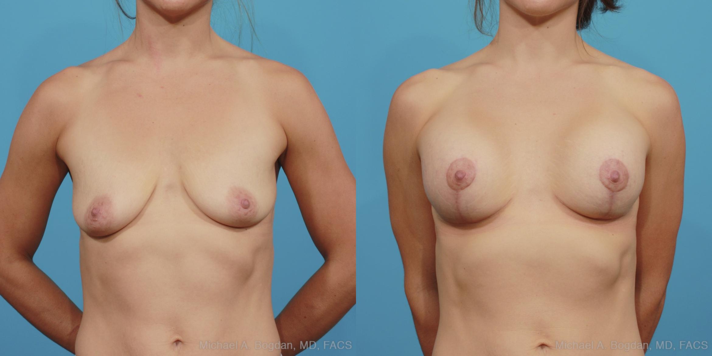 Before & After Mastopexy & Augmentation Case 375 View #1 View in Fort Worth & Frisco, Texas