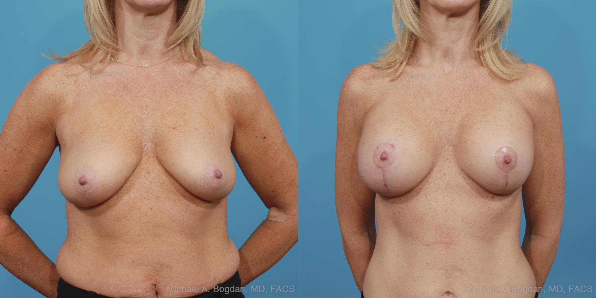 Mastopexy & Augmentation Case 389 Before & After View #1 | Fort Worth & Frisco, Texas | Michael A. Bogdan, MD, FACS