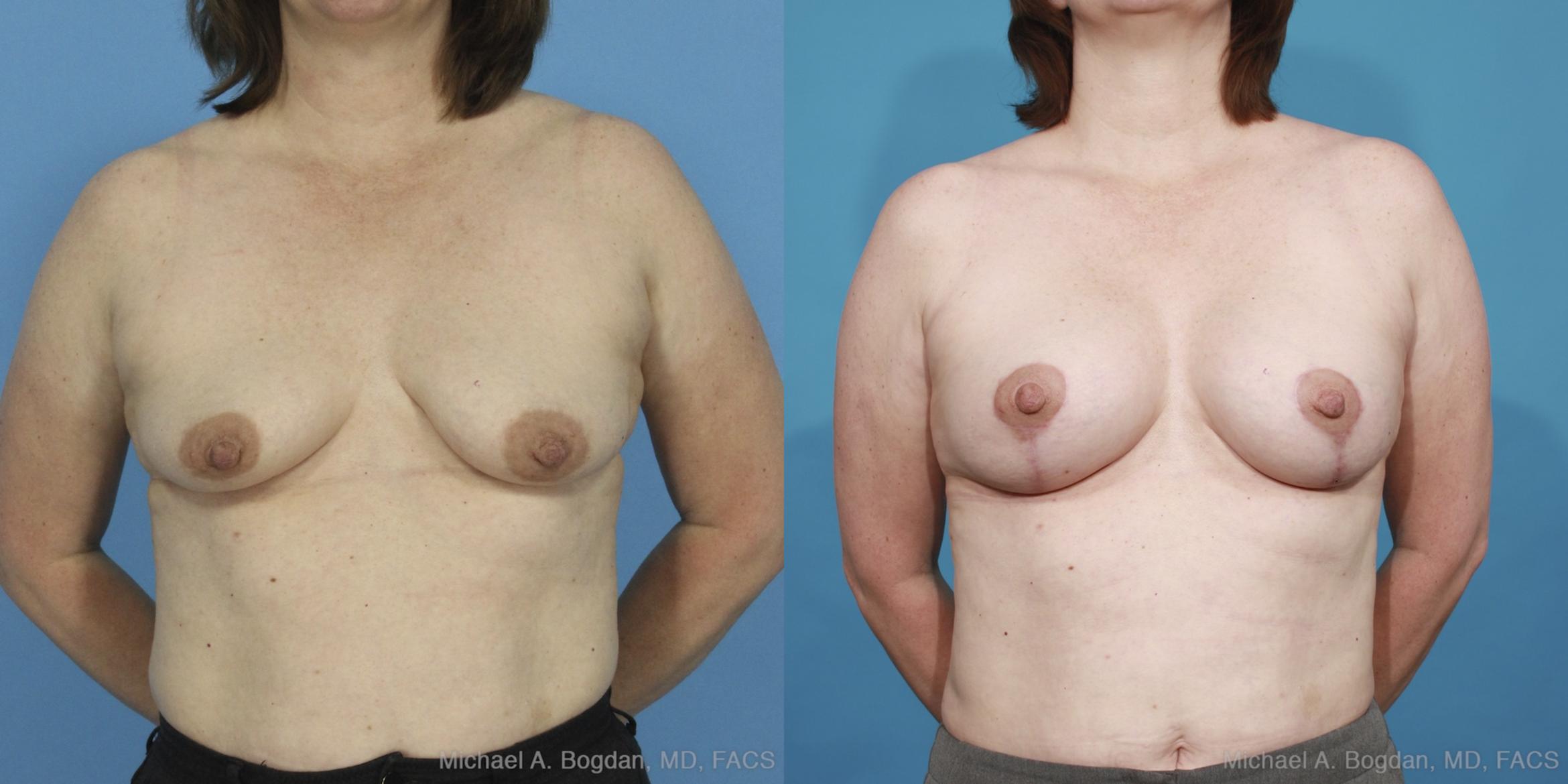 Before & After Mastopexy & Augmentation Case 424 View #1 View in Fort Worth & Frisco, Texas