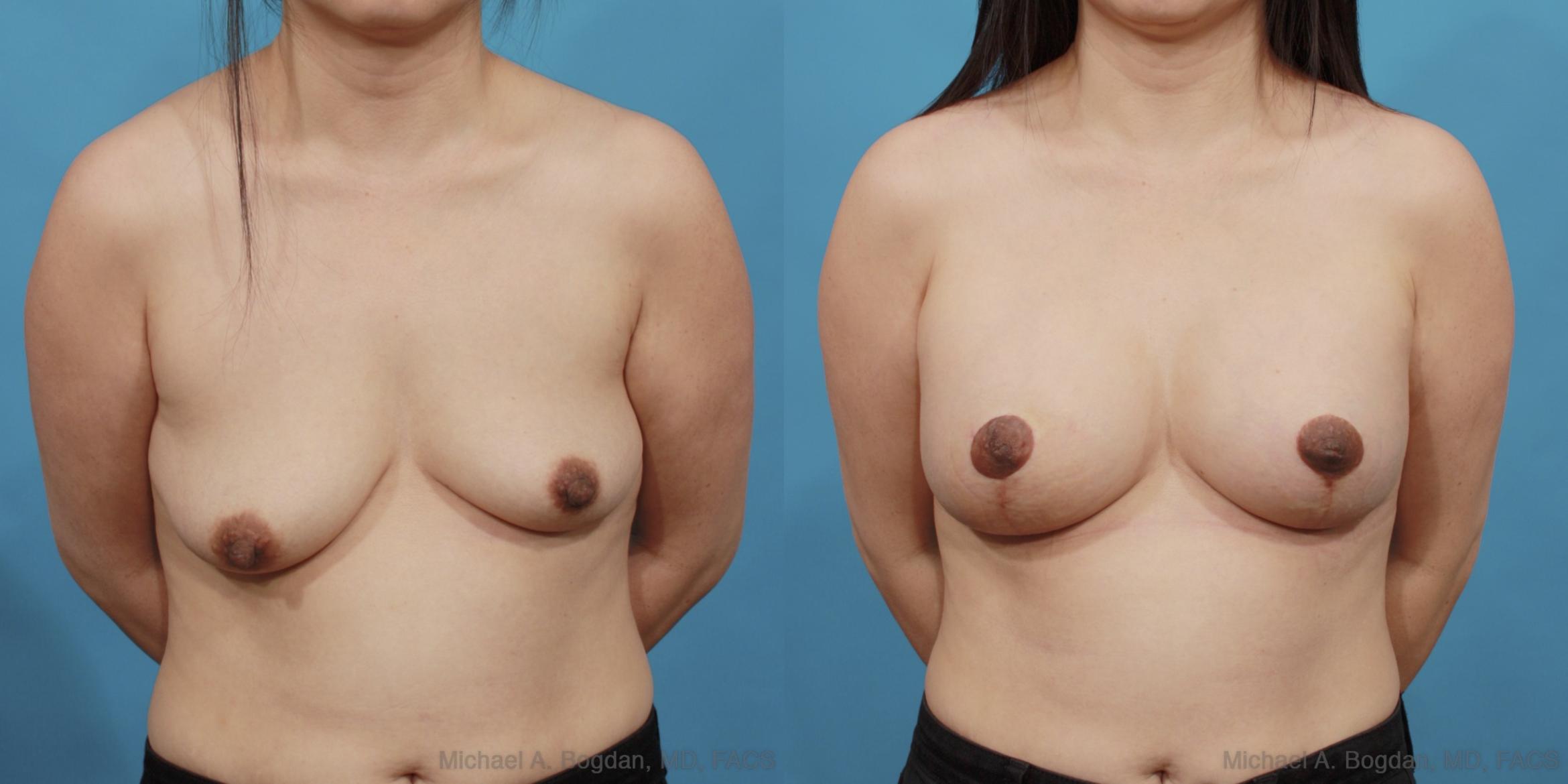 Before & After Mastopexy & Augmentation Case 537 View #1 View in Fort Worth & Frisco, Texas