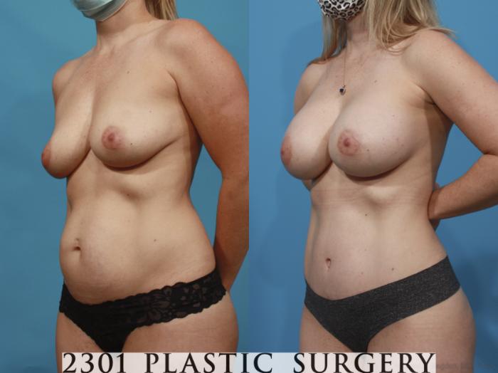 Before & After Mommy Makeover Case 665 Left Oblique View in Fort Worth, Plano, & Frisco, Texas