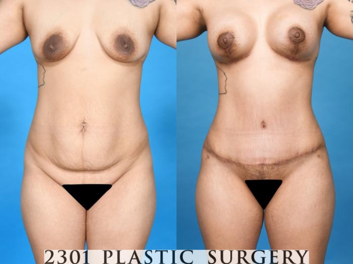 Before & After Mommy Makeover Case 750 Front View in Fort Worth, Plano, & Frisco, Texas