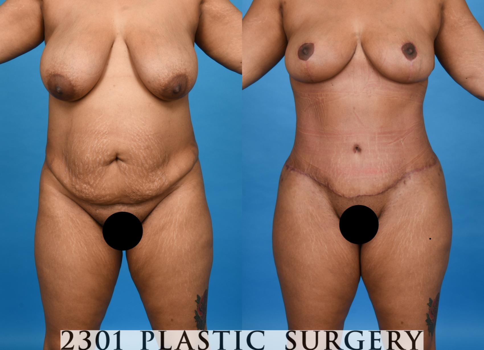 Before & After Mommy Makeover Case 758 Front View in Fort Worth, Plano, & Frisco, Texas