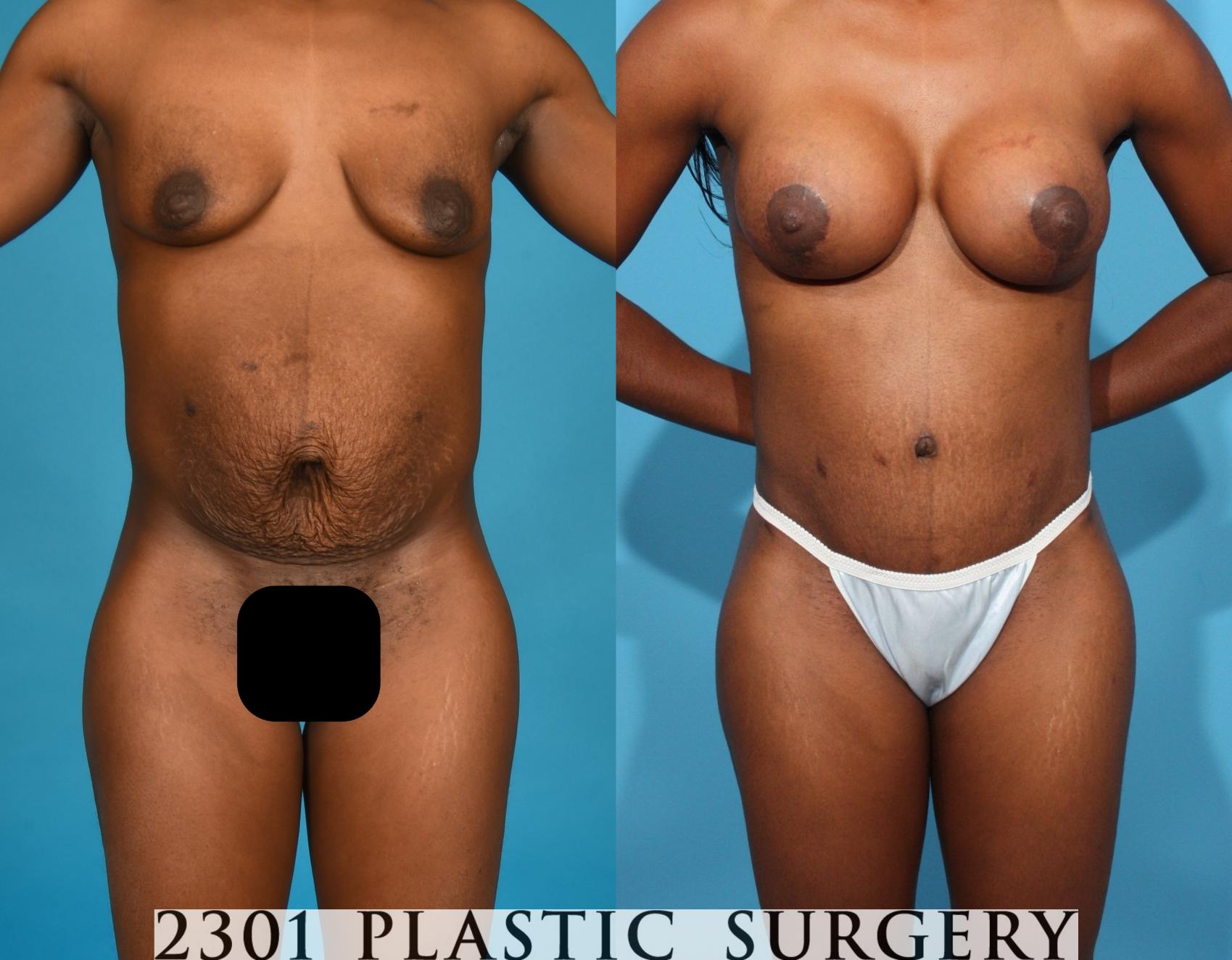 Before & After Mommy Makeover Case 761 Front View in Fort Worth, Plano, & Frisco, Texas