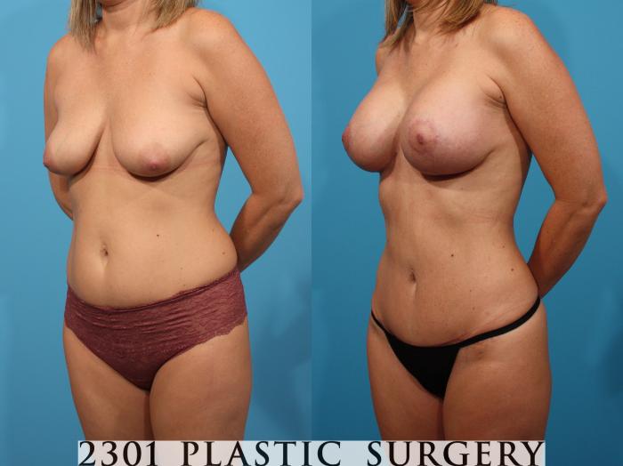 Before & After Mommy Makeover Case 765 Left Oblique View in Fort Worth, Plano, & Frisco, Texas