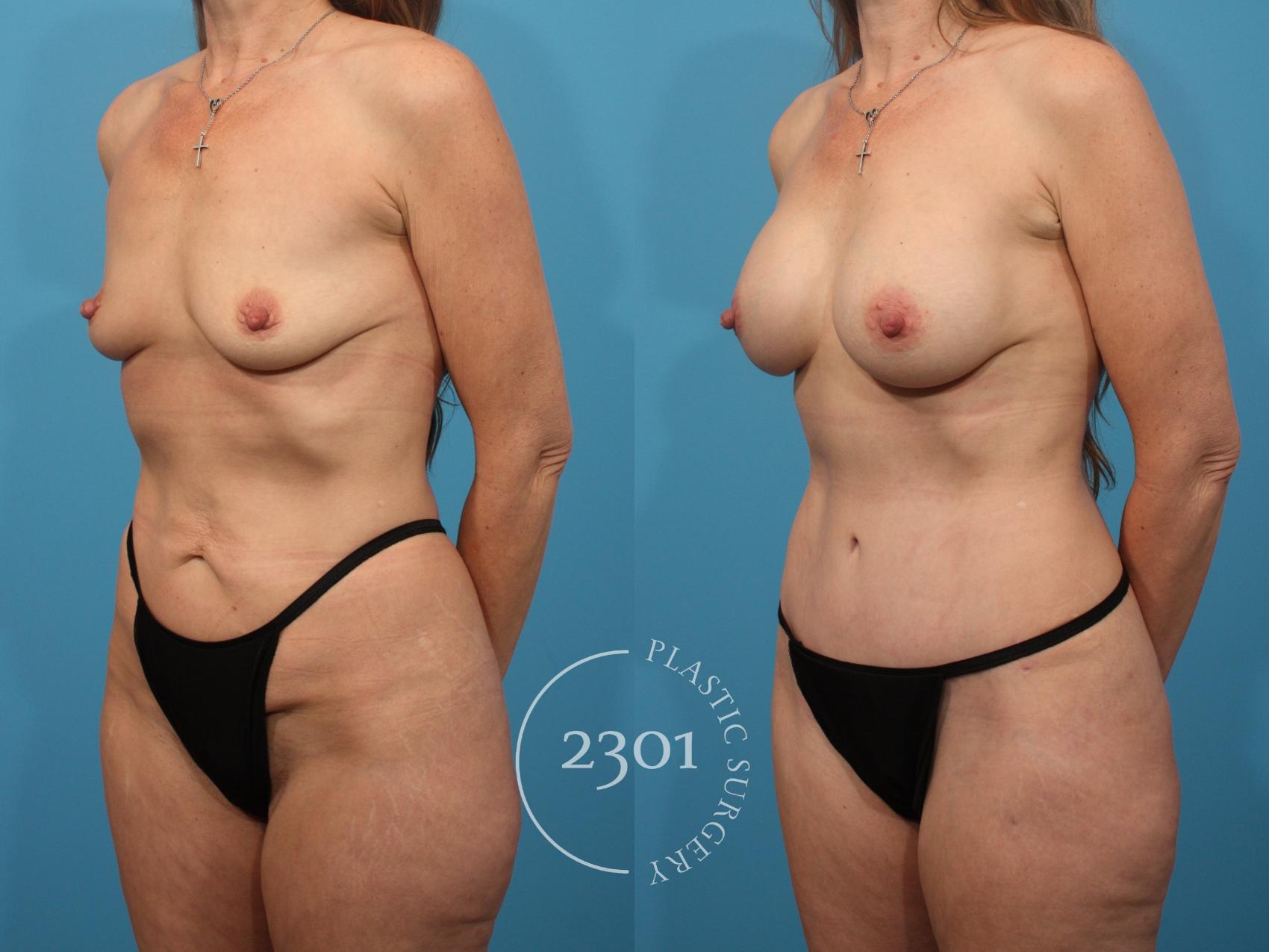Before & After Mommy Makeover Case 867 Left Oblique View in Fort Worth, Plano, & Frisco, Texas