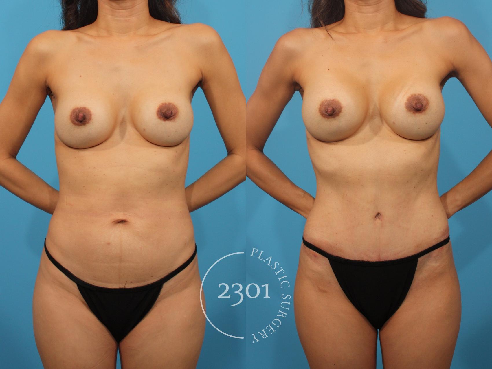 Before & After Mommy Makeover Case 881 Front View in Fort Worth, Plano, & Frisco, Texas