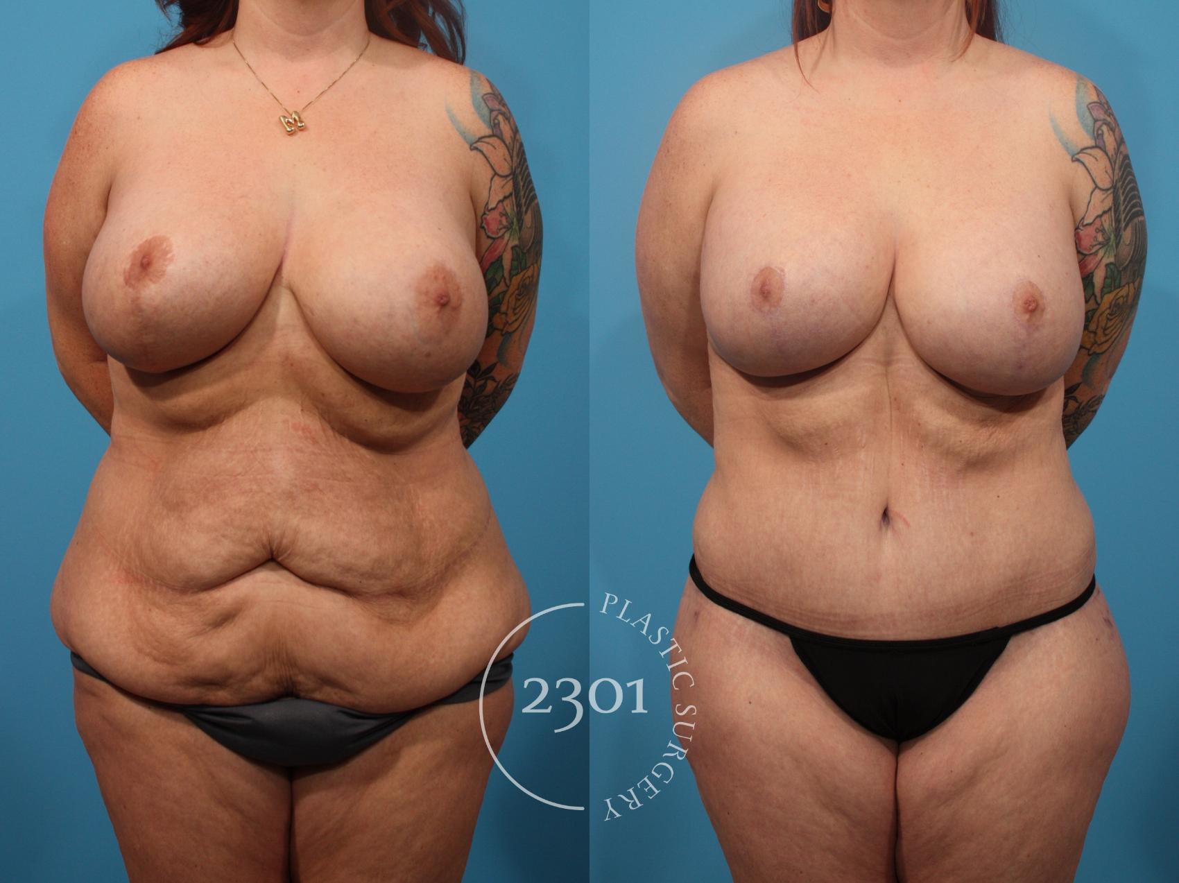 Before & After Mommy Makeover Case 885 Front View in Fort Worth, Plano, & Frisco, Texas
