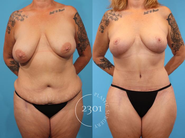 Before & After Tummy Tuck Case 902 Front View in Fort Worth, Plano, & Frisco, Texas