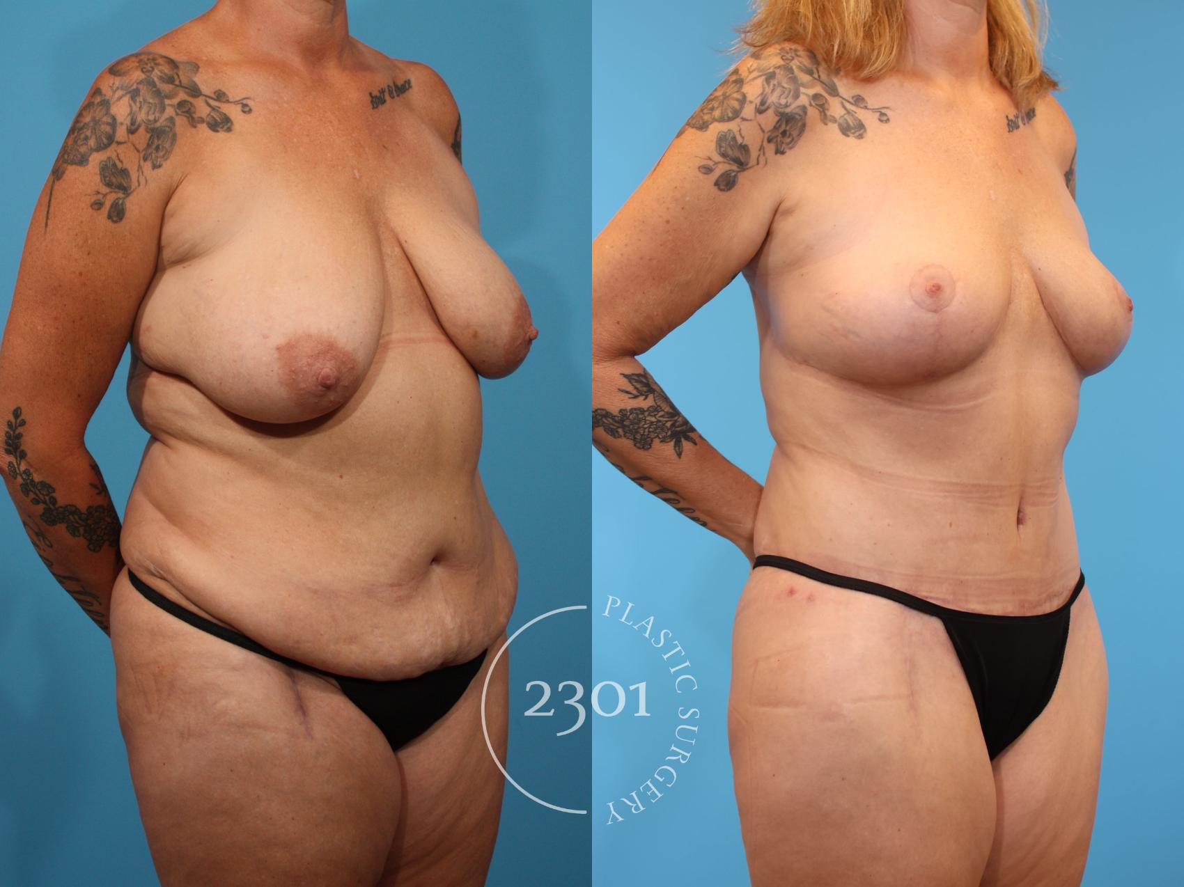 Before & After Tummy Tuck Case 902 Right Oblique View in Fort Worth, Plano, & Frisco, Texas