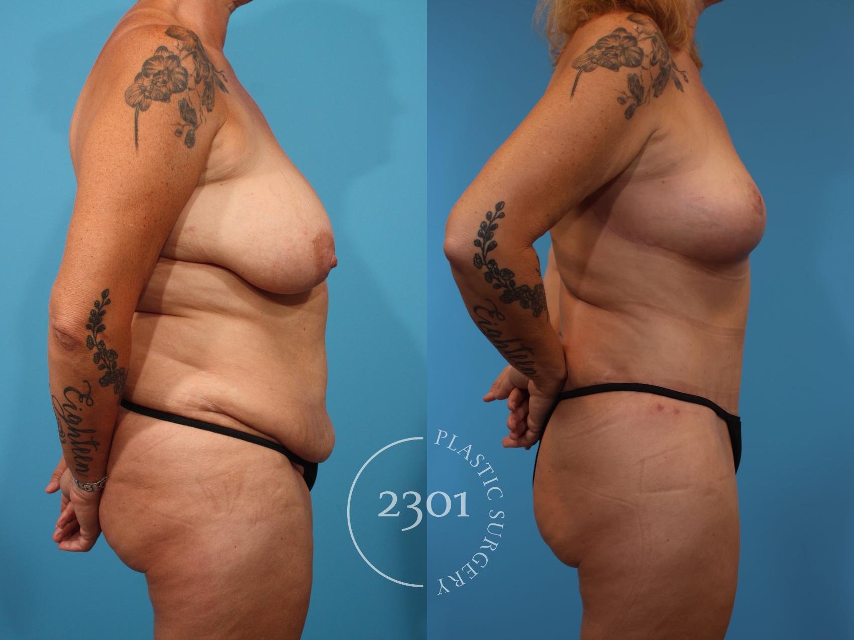 Before & After Tummy Tuck Case 902 Right Side View in Fort Worth, Plano, & Frisco, Texas