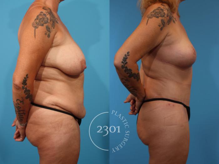 Before & After Tummy Tuck Case 902 Right Side View in Fort Worth, Plano, & Frisco, Texas