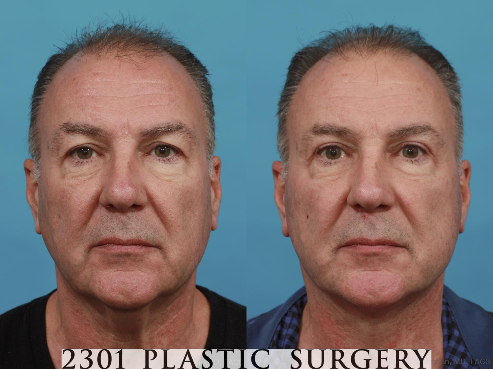 Before & After Neck Lift Case 523 View #1 View in Fort Worth, Plano, & Frisco, Texas