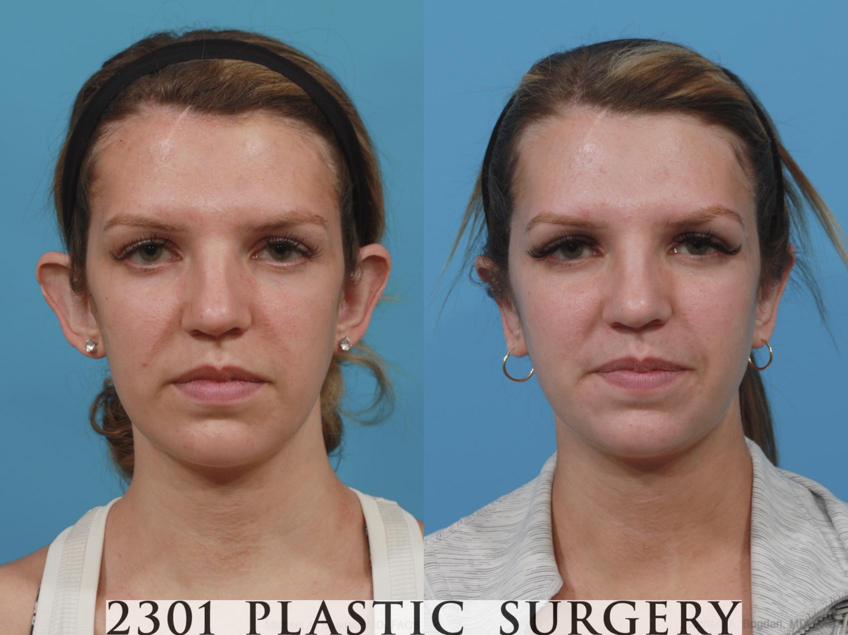 Before & After Otoplasty Case 638 Front View in Fort Worth, Plano, & Frisco, Texas