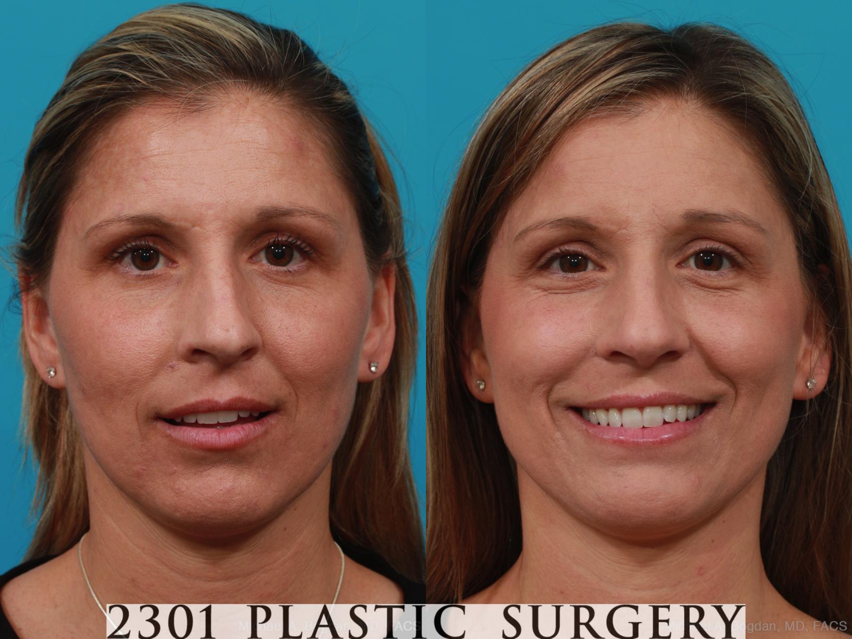 Before & After Rhinoplasty Case 280 View #1 View in Fort Worth, Plano, & Frisco, Texas