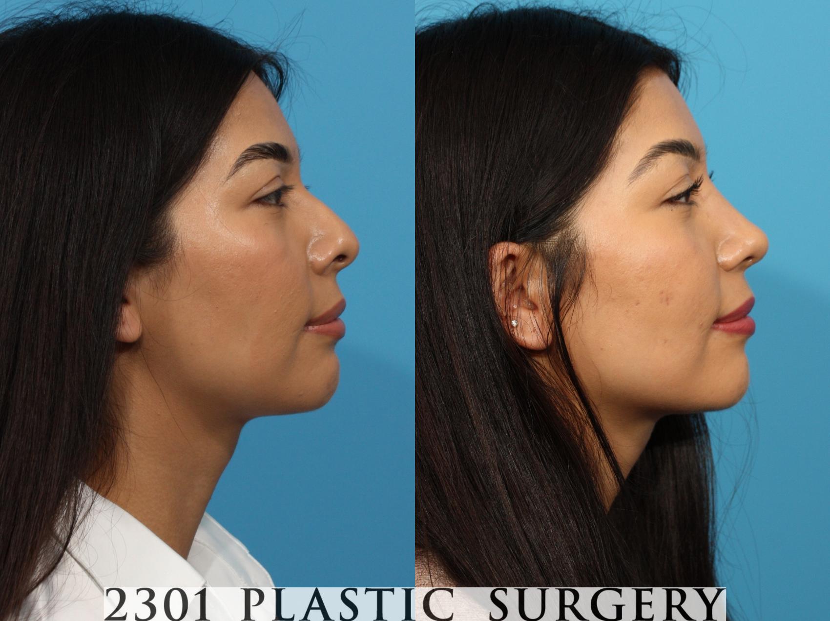 Before & After Rhinoplasty Case 766 Right Side View in Fort Worth, Plano, & Frisco, Texas