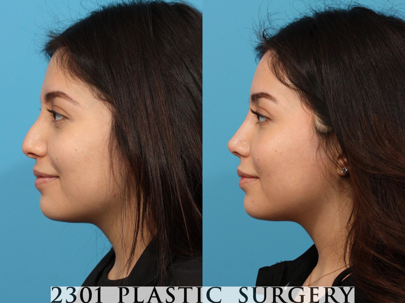 Before & After Rhinoplasty Case 772 Left Side View in Fort Worth, Plano, & Frisco, Texas