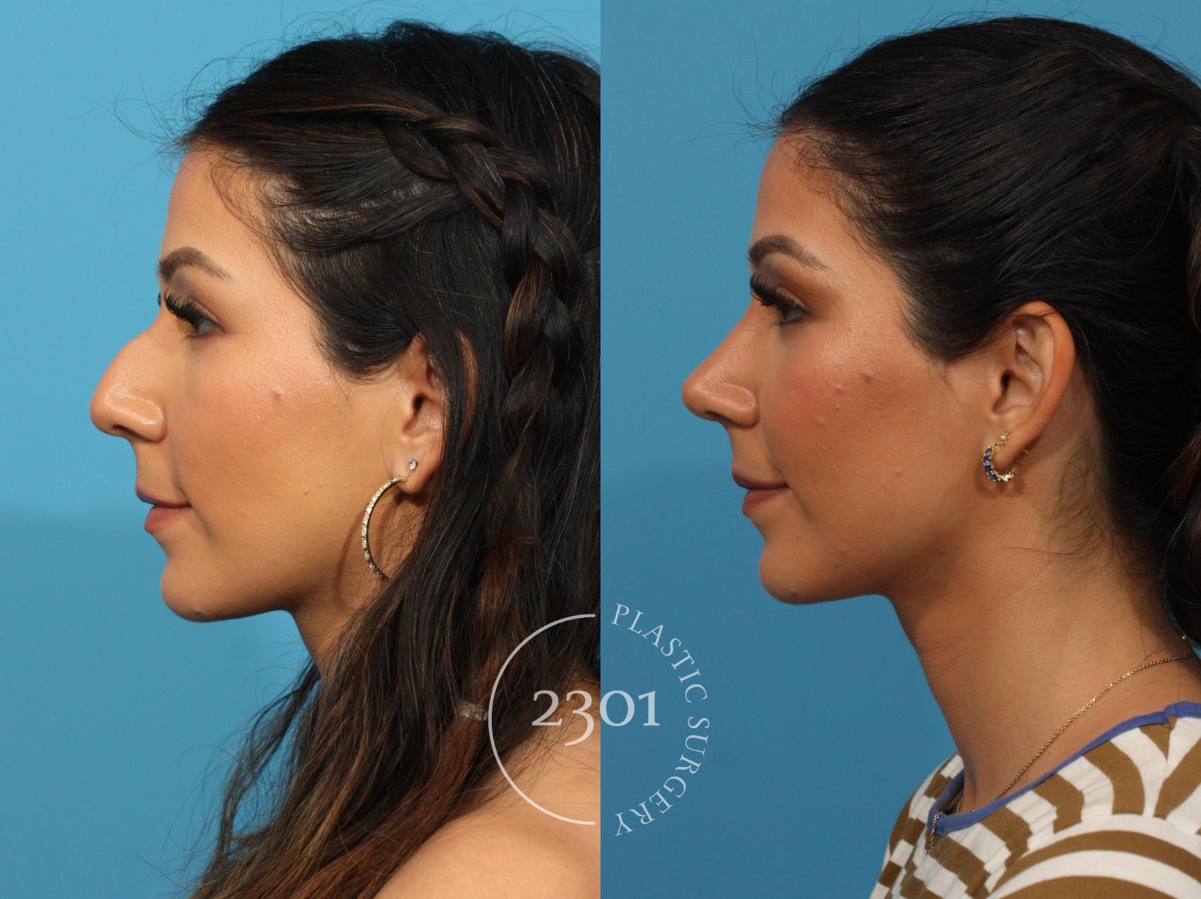 Before & After Rhinoplasty Case 861 Left Side View in Fort Worth, Plano, & Frisco, Texas