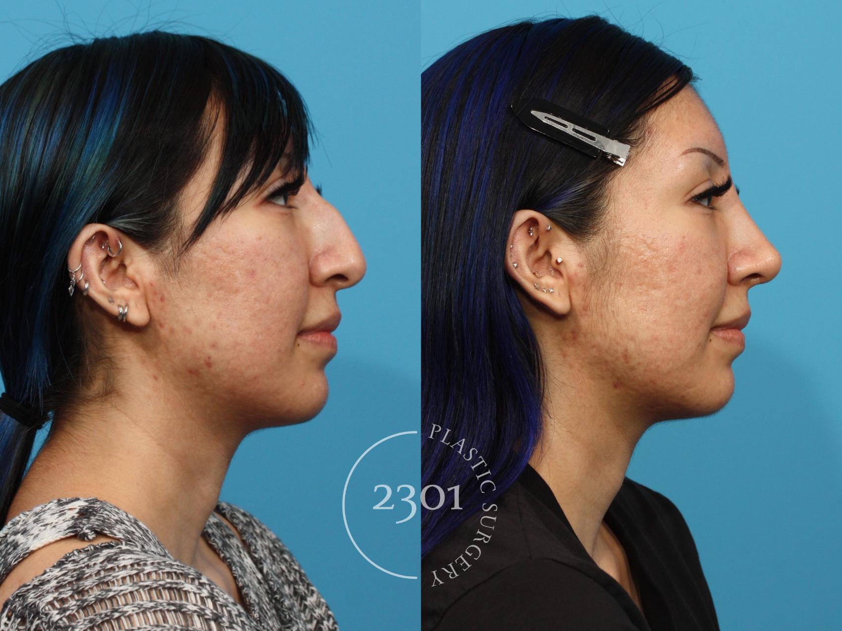 Before & After Rhinoplasty Case 862 Right Side View in Fort Worth, Plano, & Frisco, Texas