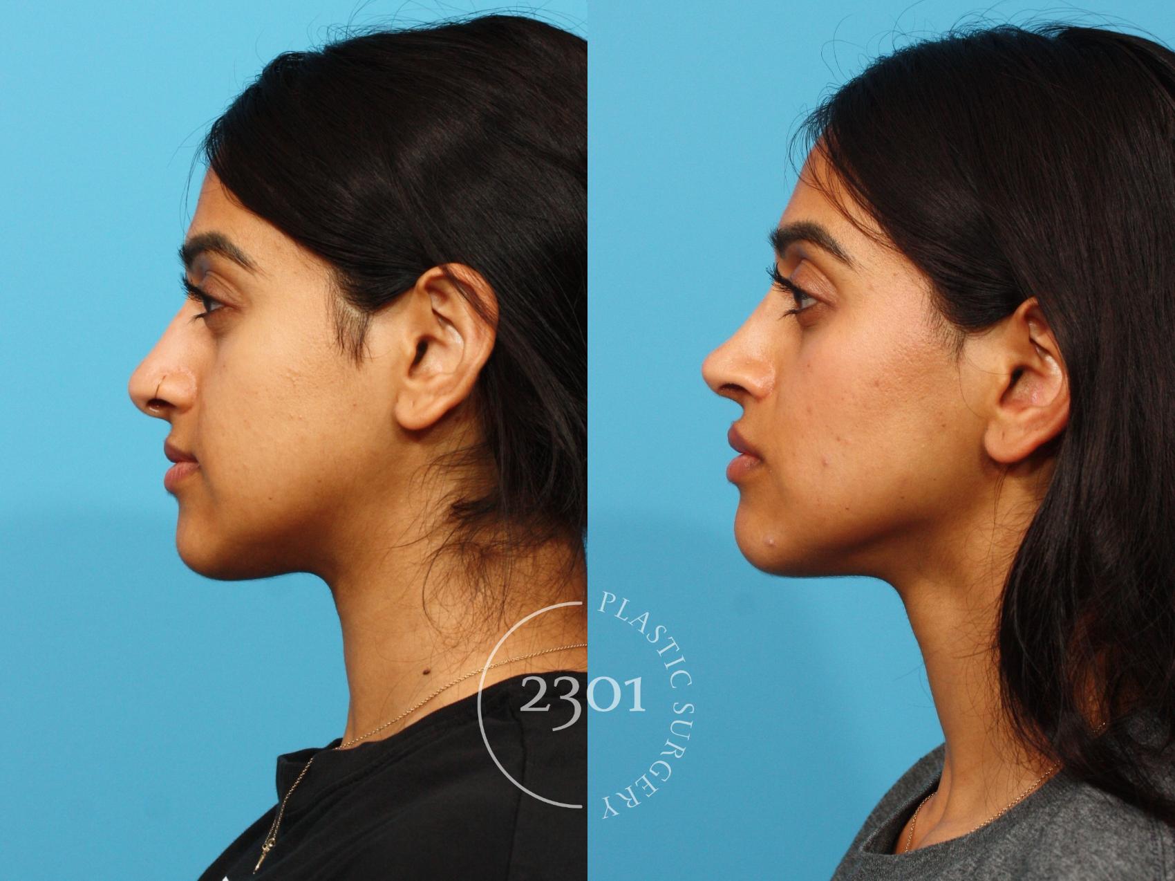 Before & After Rhinoplasty Case 863 Left Side View in Fort Worth, Plano, & Frisco, Texas