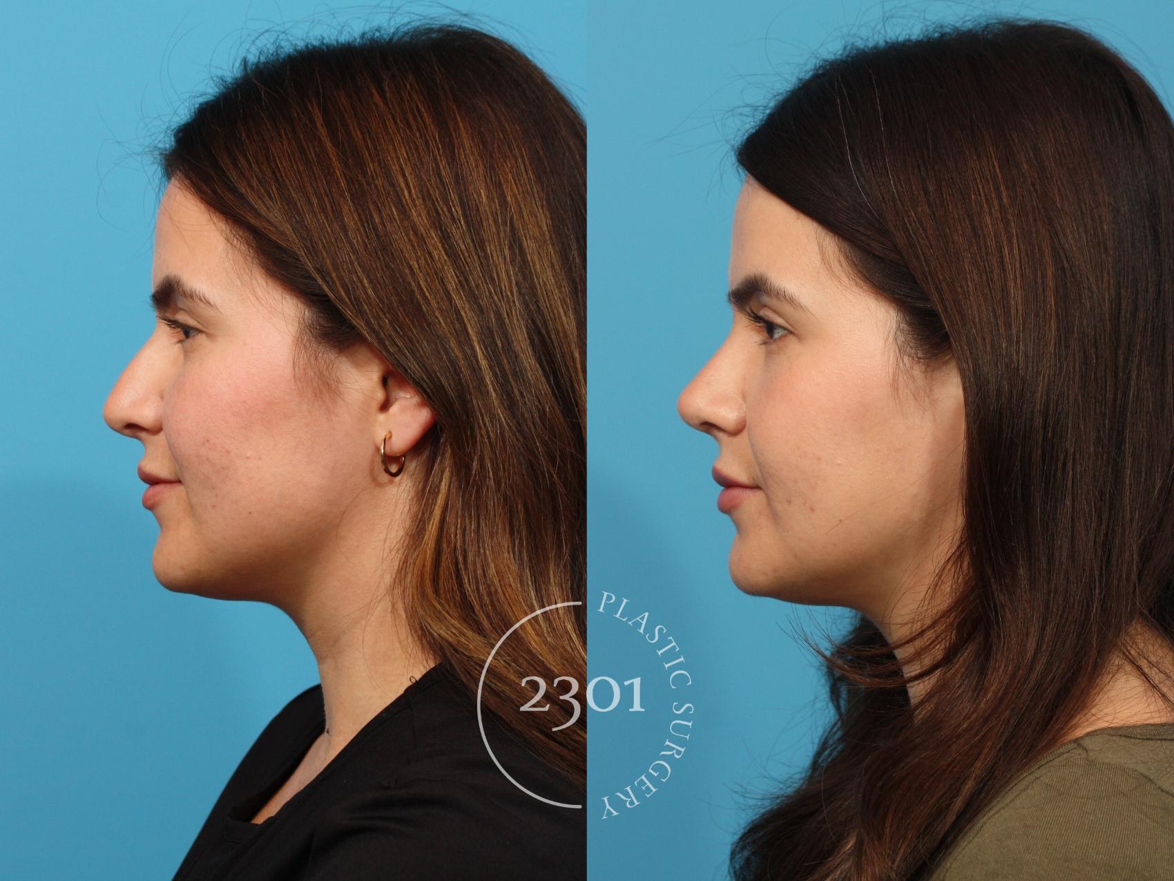 Before & After Rhinoplasty Case 864 Left Side View in Fort Worth, Plano, & Frisco, Texas