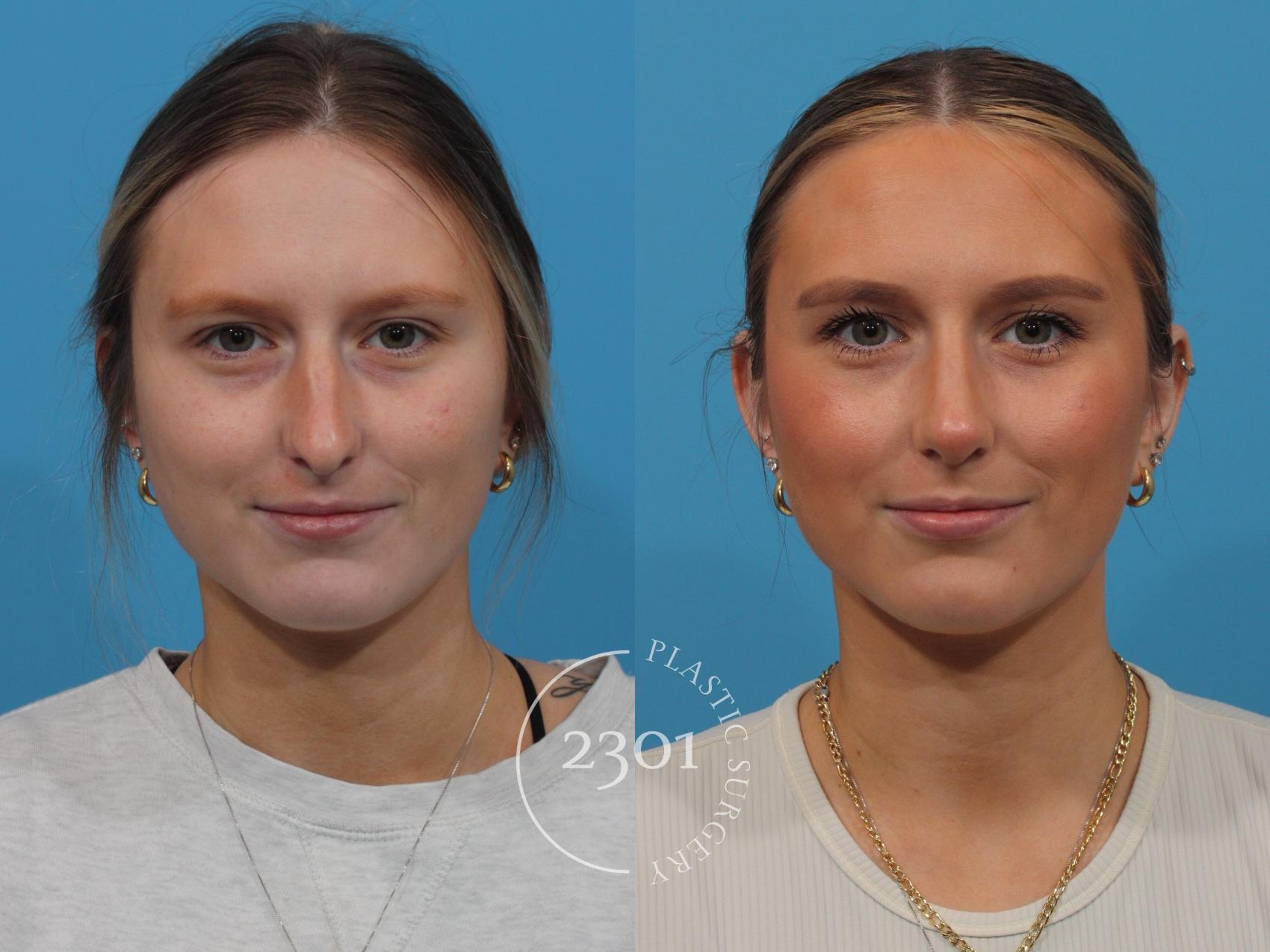 Before & After Rhinoplasty Case 865 Front View in Fort Worth, Plano, & Frisco, Texas